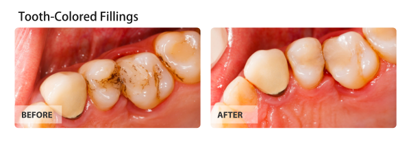 tooth-colored-fillings