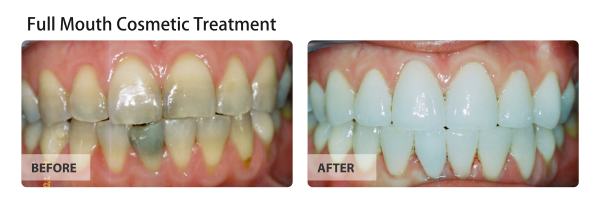 Full Mouth Cosmetic Treatment