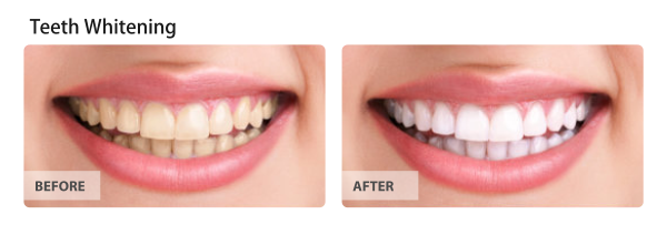 teeth-whitening